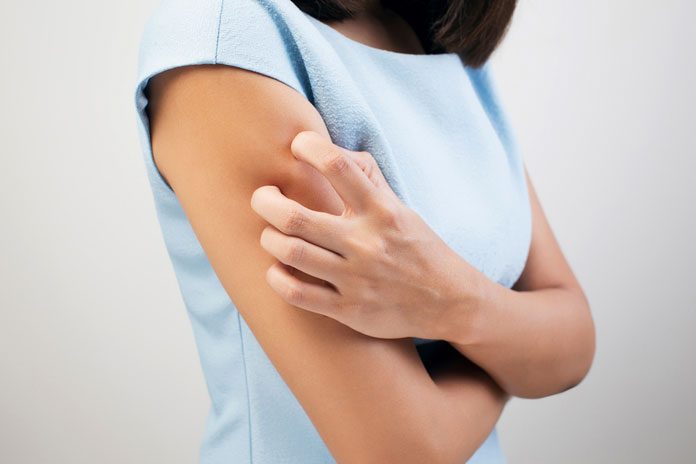 hausmittel-mückenstich 269766800 Frau kratzt sich am Arm